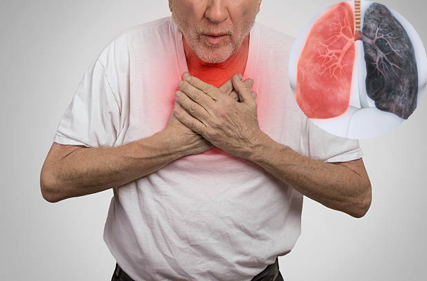 Triệu chứng bệnh phổi tắc nghẽn mạn tinh COPD